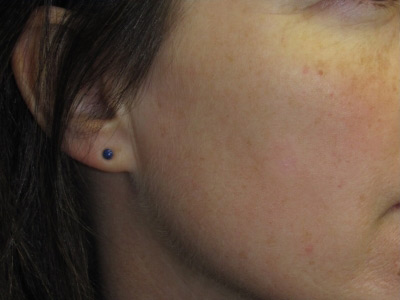 Brown Spot Removal before and after in Rhode Island