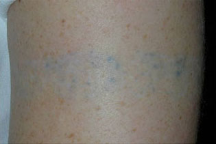 YAG Laser Before & Afters in Rhode Island
