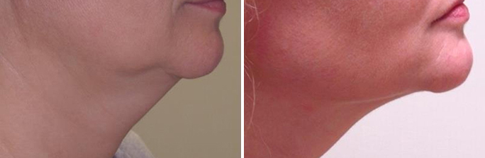 Kybella Before & After Results in Rhode Island