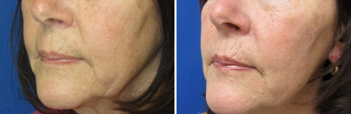 Thread Lift before and after photo by Dr. Enzer in Rhode Island