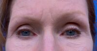 Eyelid and Upper Facial Surgery