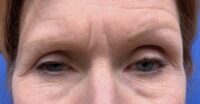 Eyelid and Upper Facial Surgery